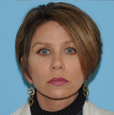 Facelift Before & After Patient #298