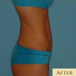 Abdominoplasty Before & After Patient #94
