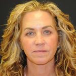 Blepharoplasty Before & After Patient #312