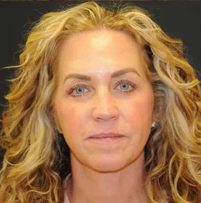 Blepharoplasty Before & After Patient #312