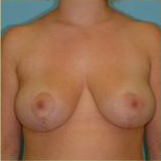 Breast Reduction Before & After Patient #333