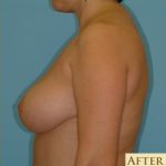 Breast Reduction Before & After Patient #347