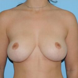 Breast Reduction Before & After Patient #354