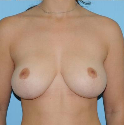 Breast Reduction Before & After Patient #354