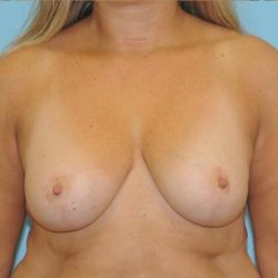 Breast Reduction Before & After Patient #375