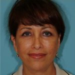 Facelift Before & After Patient #396
