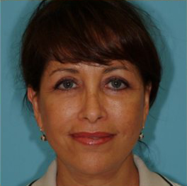 Facelift Before & After Patient #396