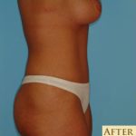 Abdominoplasty Before & After Patient #101