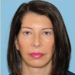Facelift Before & After Patient #410