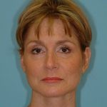 Facelift Before & After Patient #417