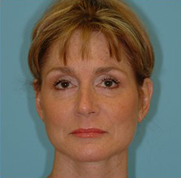 Facelift Before & After Patient #417