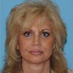 Facelift Before & After Patient #424