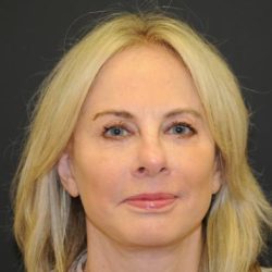 Facelift Before & After Patient #445
