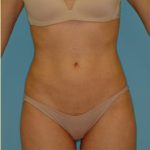 Liposuction Before & After Patient #473