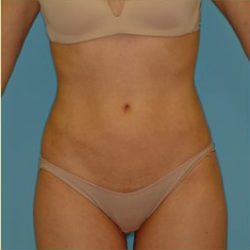 Liposuction Before & After Patient #473