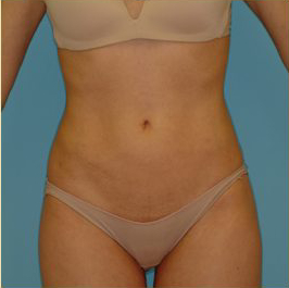 Liposuction Before & After Patient #473