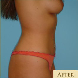 Liposuction Before & After Patient #492