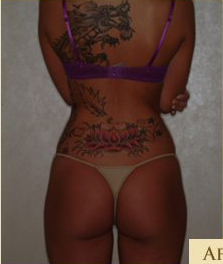 Liposuction Before & After Patient #499
