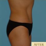 Abdominoplasty Before & After Patient #108