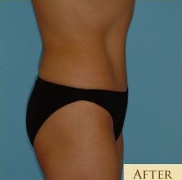 Abdominoplasty Before & After Patient #108