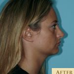 Rhinoplasty Before & After Patient #560