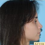 Rhinoplasty Before & After Patient #574