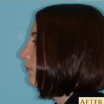 Rhinoplasty Before & After Patient #581