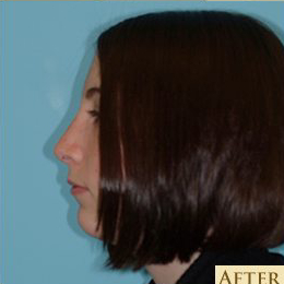 Rhinoplasty Before & After Patient #581