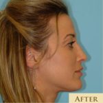 Rhinoplasty Before & After Patient #588