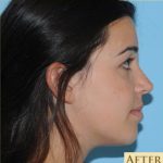 Rhinoplasty Before & After Patient #595