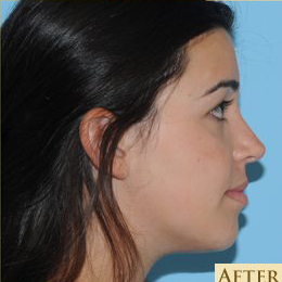 Rhinoplasty Before & After Patient #595