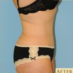Abdominoplasty Before & After Patient #115