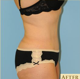 Abdominoplasty Before & After Patient #115