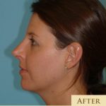 Rhinoplasty Before & After Patient #623