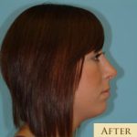 Rhinoplasty Before & After Patient #644