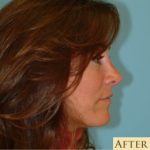 Rhinoplasty Before & After Patient #651