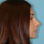 Rhinoplasty Before & After Patient #658
