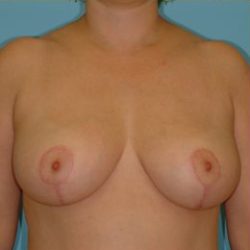 Mastopexy Before & After Patient #735