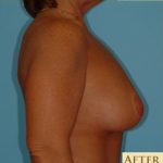 Mastopexy Before & After Patient #756