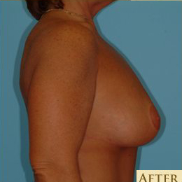 Mastopexy Before & After Patient #756