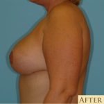 Mastopexy Before & After Patient #763