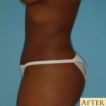 Abdominoplasty Before & After Patient #122