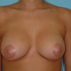 Mastopexy Before & After Patient #777