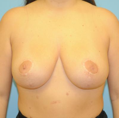 Breast Reduction Before & After Patient #818