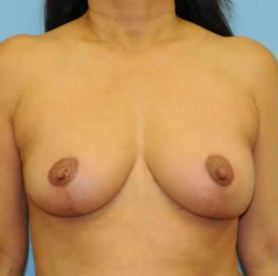 Mastopexy Before & After Patient #825