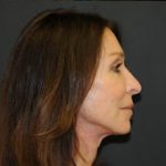 Facelift Before & After Patient #326