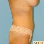 Abdominoplasty Before & After Patient #129