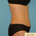 Abdominoplasty Before & After Patient #136