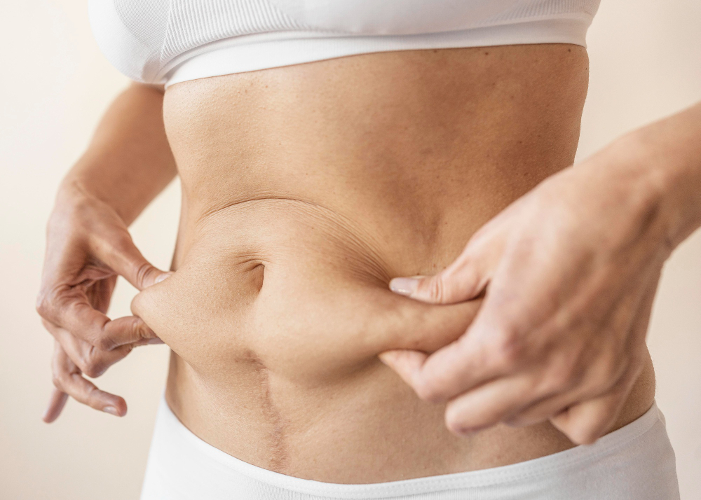 Abdominoplasty in Manhattan and Cedar Grove
