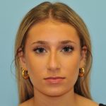 Rhinoplasty Before & After Patient #2829